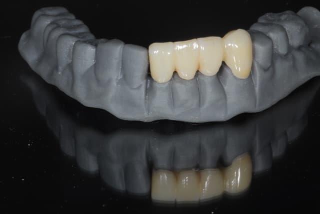 Dental crown and bridge