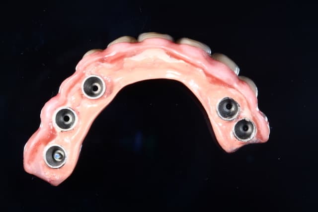 Dental implant structure
