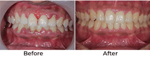 Gum treatment before and after