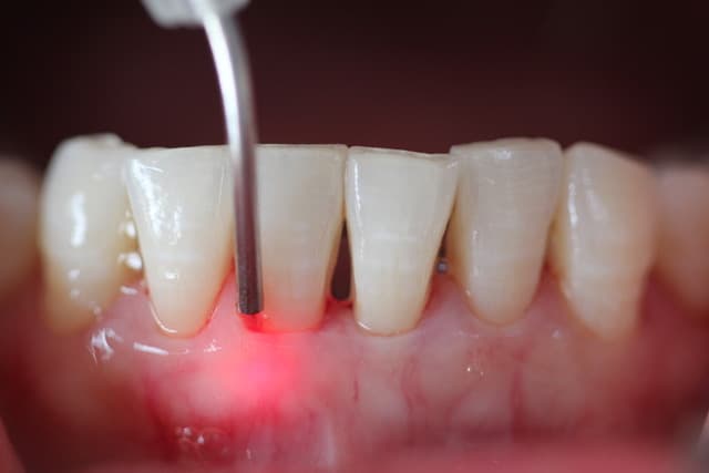 Dental laser treatment