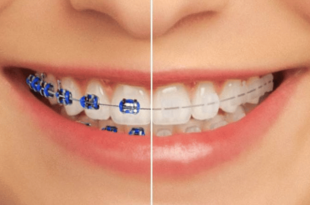 Orthodontic braces