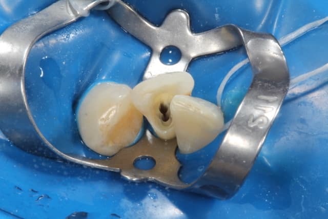 Root canal procedure